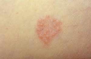 Granuloma Annulare: What are the Main Causes? - Techicy